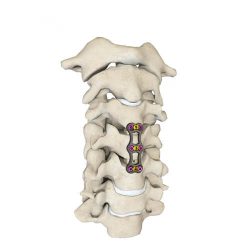 Anterior Cervical Plate – Type II