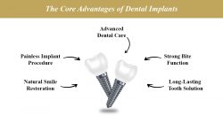 Advanced Dental Implants for a Natural Smile