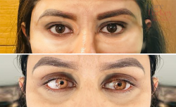 Keratopigmentation Cost Breakdown for Eye Color Change