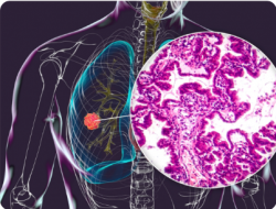 Why Quitting Isn’t Enough: Understanding the Real Causes of Lung Cancer