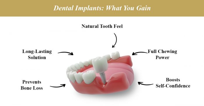Smile Strong with Dental Implants