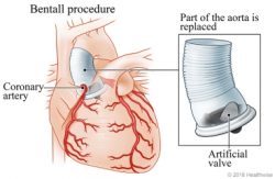 Bentall Surgery Cost in India – Affordable Treatment at Hospisity