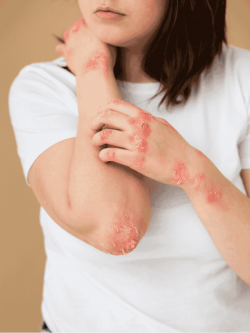 Effective Psoriasis Treatment in Mumbai – Natural Ayurvedic Care