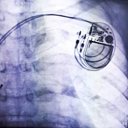 Pacemaker Implantation surgery cost in India – Hospisity