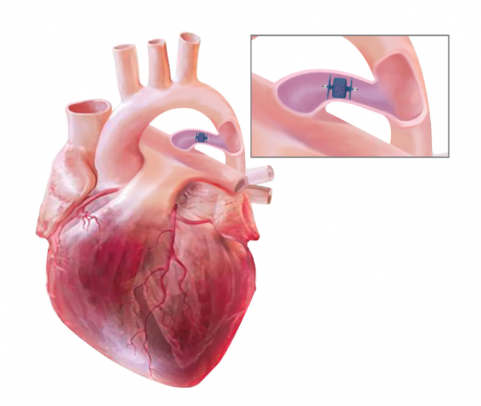PDA Closure Surgery Cost in India – HOSPISITY