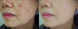 Why Some Pigmentation Treatments Actually Make Your Skin Darker