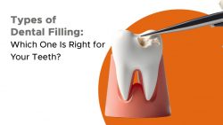 Choosing the Right Dental Filling for Your Smile
