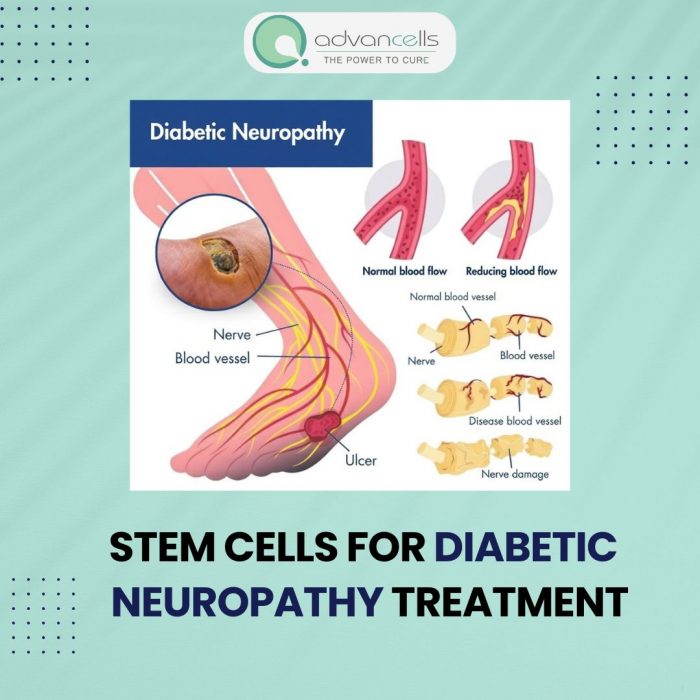 Stem Cells for Diabetic Neuropathy Treatment | Advancells