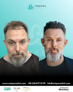 Direct Hair Implantation