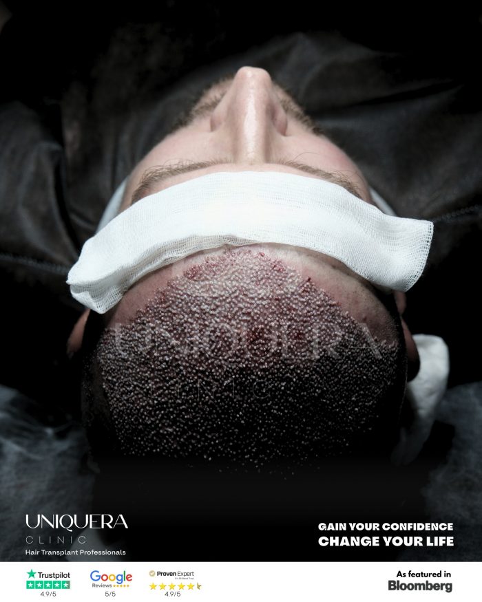 Direct hair implantation