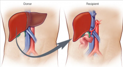 Liver Transplant Surgery Cost in India – Affordable Care with Hospisity