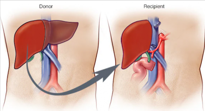 Liver Transplant Surgery Cost in India – Affordable Care with Hospisity