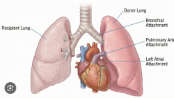 Lung Transplant Surgery Cost in India — Hospisity