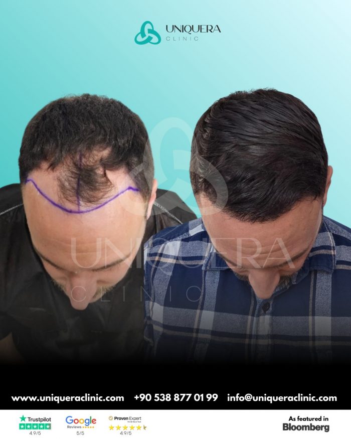 Sapphire Fue Hair Transplant Turkey