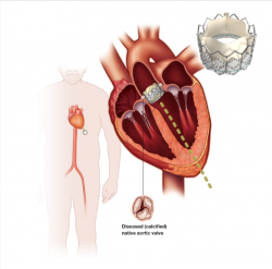 Transcatheter Valve Replacement Surgery Cost in India – Hospisity