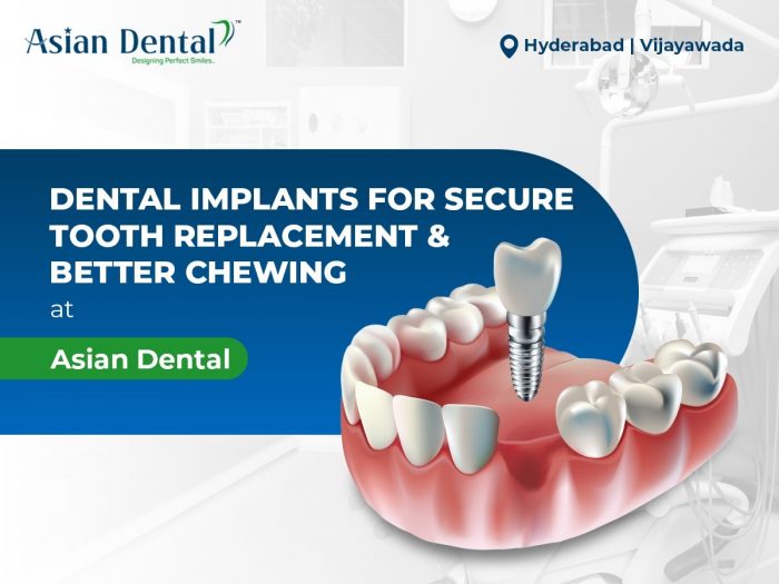 Dental Implants in Hyderabad | Secure & Natural Tooth Replacement – Asian Dental