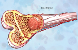 Bone Marrow Transplant Cost in India – HOSPISITY