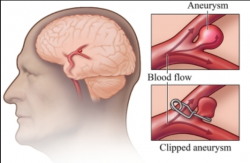 Brain Aneurysm Repair Surgery Cost India – Hospisity