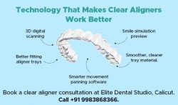 Advanced Technology Behind Clear Aligners for Better Smile Results