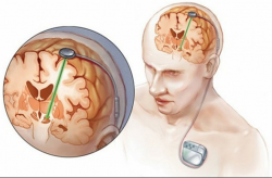 Deep Brain Stimulation Surgery Cost in India – Hospisity