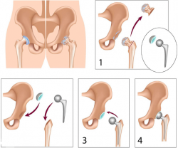 Hip Replacement Surgery Cost in India – HOSPISITY