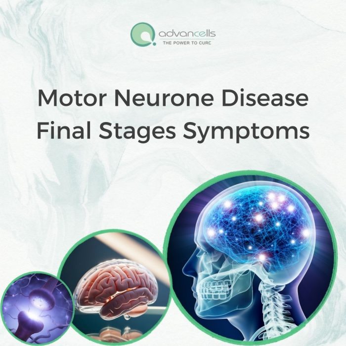 Illustration of Motor Neurone Disease (MND) Progression
