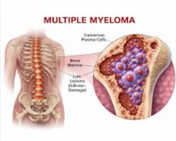 Multiple Myeloma Treatment Cost in India – HOSPISITY