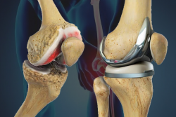 Knee Replacement Surgery Cost in India – HOSPISITY