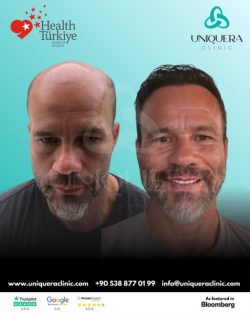 Luxury Hair Transplant Turkey – Uniquera Clinic