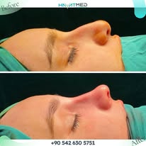 VASER Liposuction Turkey – Advanced Body Contouring at HayatMedClinic