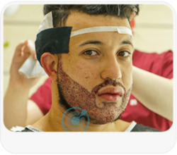 BlueMagic Group’s Premium Best Beard Transplant Services in Turkey