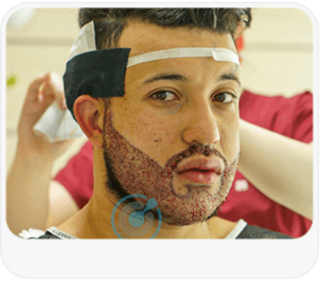 BlueMagic Group’s Premium Best Beard Transplant Services in Turkey
