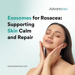 Exosomes for Rosacea: Supporting Skin Calm and Repair