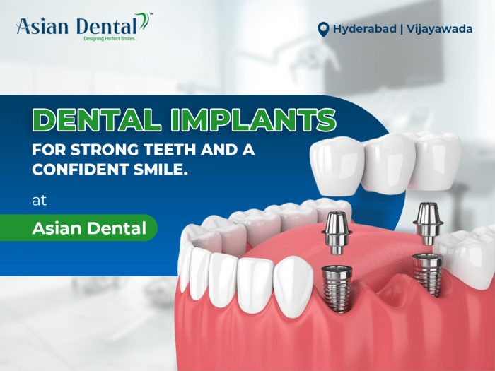 Restore Your Smile with Dental Implants
