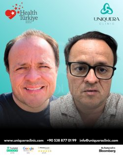 DHI Hair Transplant Before and After Results – Uniquera Clinic Turkey