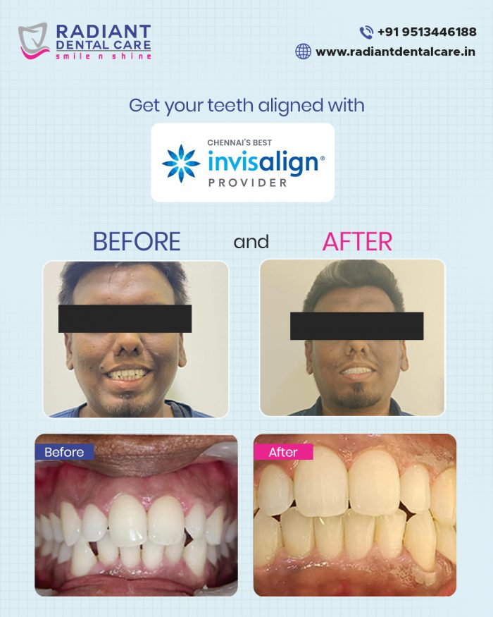 Invisalign Smile Makeover in Chennai