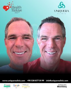 Organic Hair Transplant in Turkey for Natural Growth – Uniquera Clinic