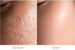 Acne Scars Treatment in Delhi at Iksana Wellness