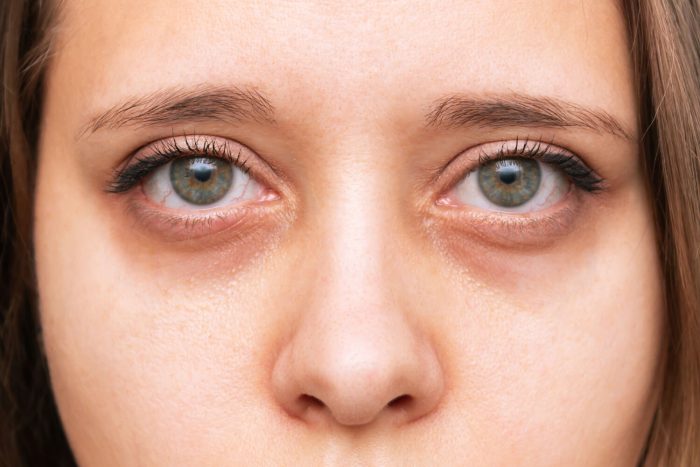 Under Eye Hollowness Treatment in Delhi: Restore Volume & Brighten Eyes