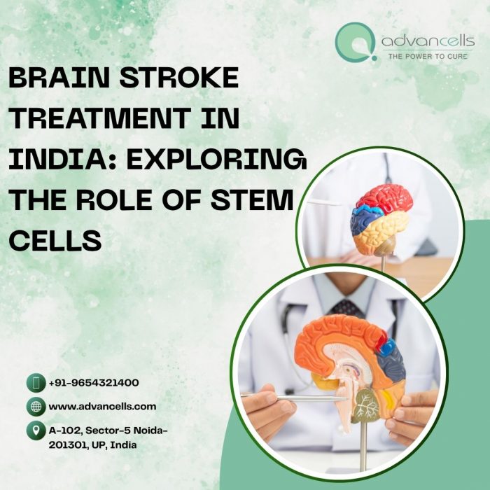 Brain Stroke Treatment in India: Exploring the Role of Stem Cells