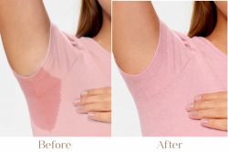 Excessive Sweating Treatment in Delhi