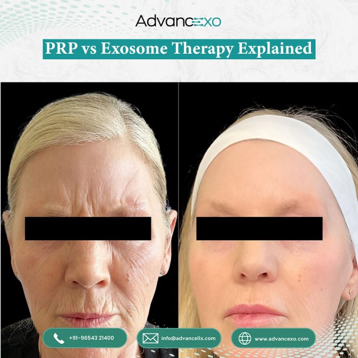 PRP vs Exosome Therapy Explained