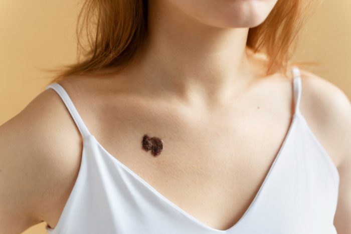 Skin Tag Removal in Delhi