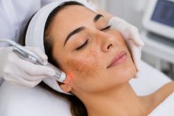 Melasma Treatment in Delhi for Clearer, Even-Toned Skin