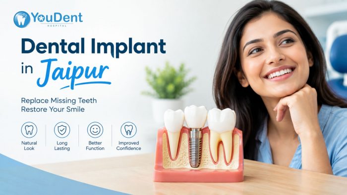 Dental Implant in Jaipur | Youdent – Strong Teeth, Confident Smiles